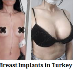Breast Implant in Turkey