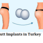 Butt Implants in Turkey