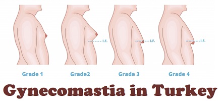 Gynecomastia in Turkey
