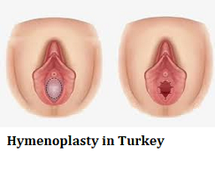 Hymenoplasty in Turkey