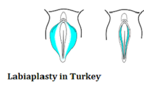 Labiaplasty in Turkey