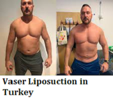 Vaser Liposuction in Turkey