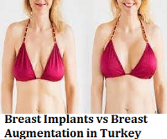 Breast Implants vs Breast Augmentation in Turkey