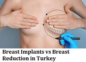 Breast Implants vs Breast Reduction in Turkey