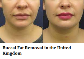 Buccal Fat Removal in the United Kingdom