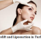 Facelift and Liposuction in Turkey
