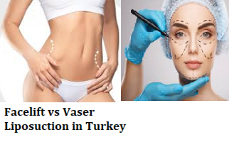 Facelift vs Vaser Liposuction in Turkey