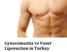 Gynecomastia vs Vaser Liposuction in Turkey