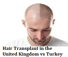 Hair Transplant in the United Kingdom vs Turkey