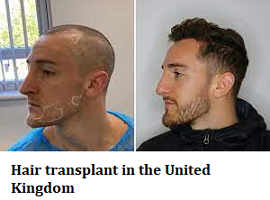 Hair transplant in the United Kingdom
