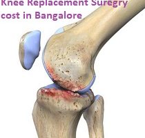 Knee Replacement Surgery in Bangalore