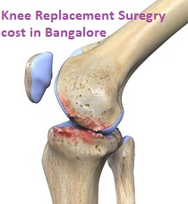Knee Replacement Surgery in Bangalore