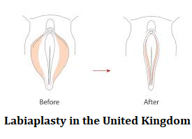 Labiaplasty in the United Kingdom