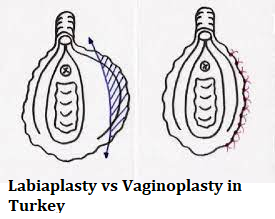 Labiaplasty vs Vaginoplasty in Turkey