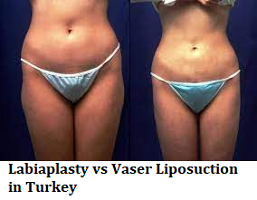 Labiaplasty vs Vaser Liposuction in Turkey