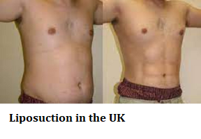 Liposuction in the UK