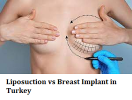 Liposuction vs Breast Implant in Turkey