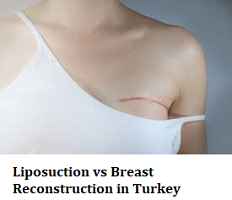 Liposuction vs Breast Reconstruction in Turkey