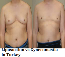 Liposuction vs Gynecomastia in Turkey