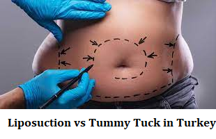 Liposuction vs Tummy Tuck in Turkey