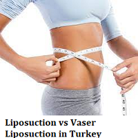 Liposuction vs Vaser Liposuction in Turkey