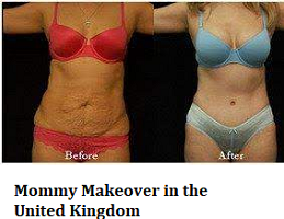 Mommy Makeover in the United Kingdom