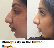 Rhinoplasty in the United Kingdom