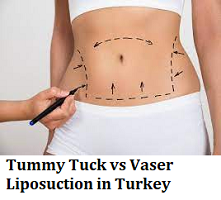 Tummy Tuck vs Vaser Liposuction in Turkey