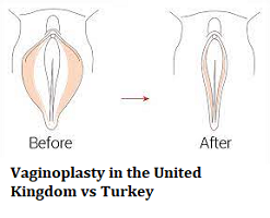 Vaginoplasty in the United Kingdom vs Turkey