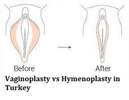 Vaginoplasty vs Hymenoplasty in Turkey