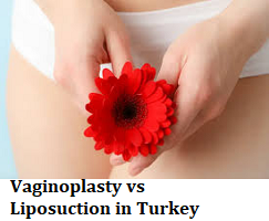 Vaginoplasty vs Liposuction in Turkey