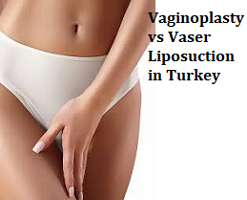 Vaginoplasty vs Vaser Liposuction in Turkey