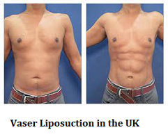 Vaser Liposuction in the UK