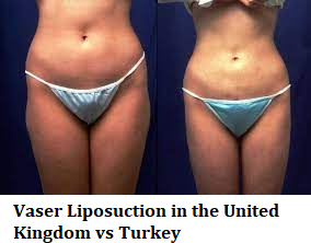 Vaser Liposuction in the United Kingdom vs Turkey