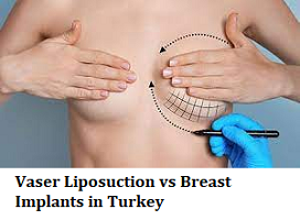 Vaser Liposuction vs Breast Implants in Turkey
