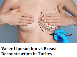 Vaser Liposuction vs Breast Reconstruction in Turkey
