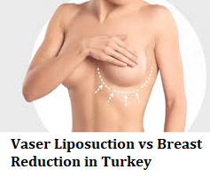 Vaser Liposuction vs Breast Reduction in Turkey