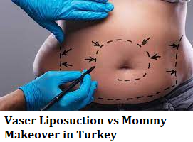 Vaser Liposuction vs Mommy Makeover in Turkey